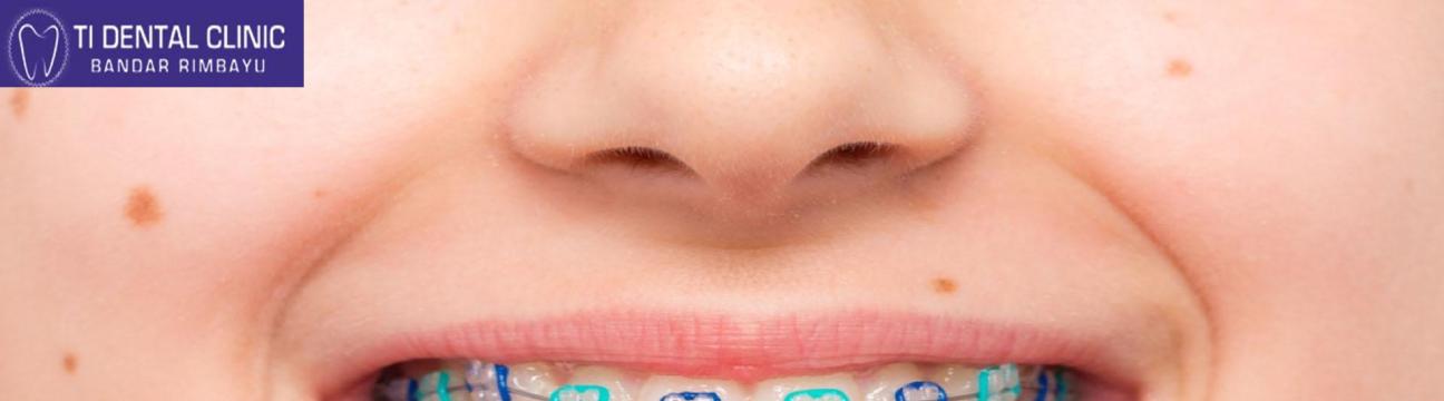 Cost of Invisible Braces in India